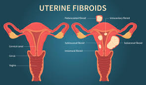 Understanding Uterine Fibroids: Impact, Statistics, and Holistic Healing