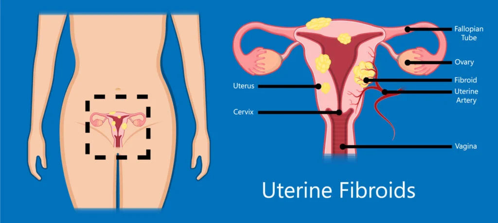 Fibroids: Let's Talk About It